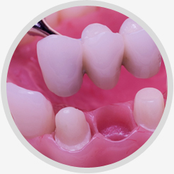 Broken/Loose Tooth Crown Repair