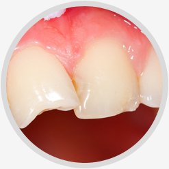 Broken Teeth Restoration Treatment