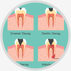 Abscessed Tooth Treatment