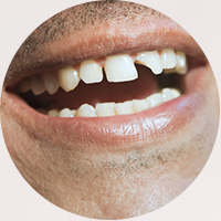 Broken Tooth Treatment