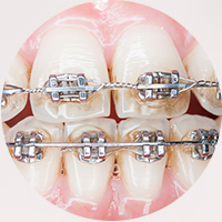 Orthodontic Emergency Care